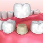 When Should You Opt For Dental Crowns?