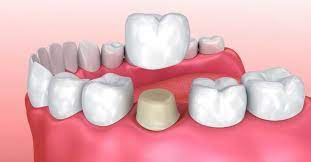 When Should You Opt For Dental Crowns?
