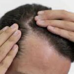 Average Cost of Hair Transplant