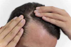 Average Cost of Hair Transplant