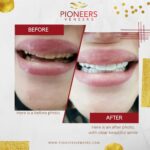 How The Benefits From Snap On Veneers Can Change Your Life