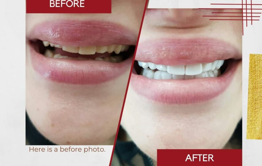 How The Benefits From Snap On Veneers Can Change Your Life
